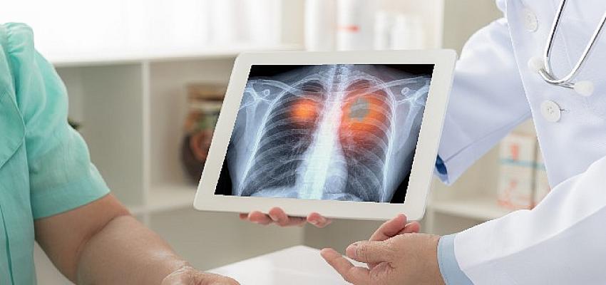 Amerikan Kanseri Derneği açıkladı akciğer kanserinde tarama yaşı düştü